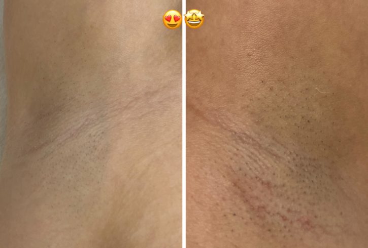 Servicii De Epilare Definitiva Cu Laser In Finchley Road, Londra