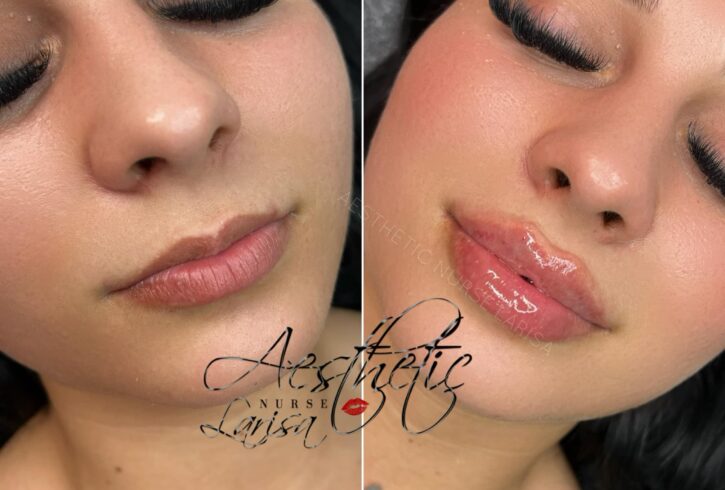 Proceduri Estetică Medicala Acid Hialuronic În Harrow, Londra