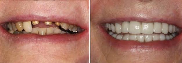 Servicii Stomatologice Implanturi in Leicester, UK Servicii Stomatologice Implanturi in Leicester, UK