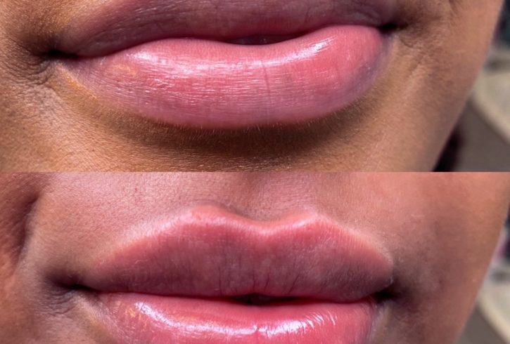 Injectare Acid Hialuronic - Russian Lips Injectare Acid Hialuronic - Russian Lips